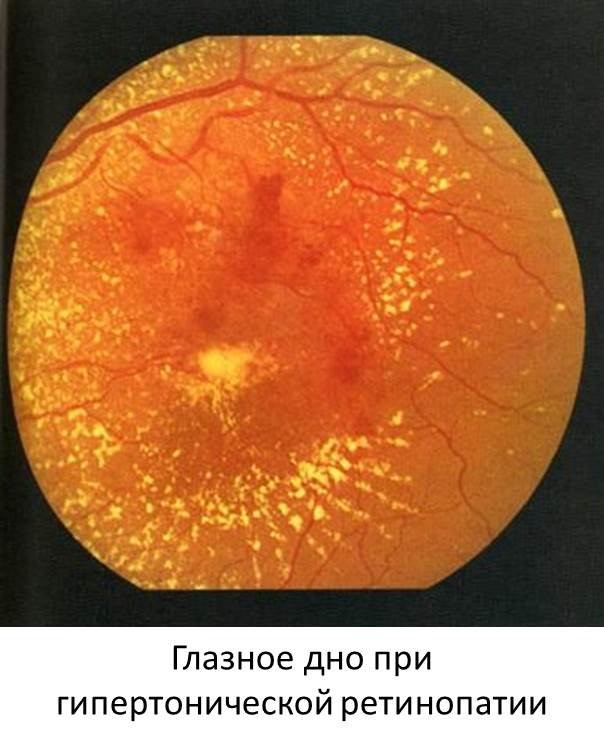 Изменение на глазном дне. Гипертоническая ретинопатия глазное дно. Почечная гипертоническая ретинопатия. Альбуминурическая ретинопатия. Ретинопатия гипертоническая болезнь.
